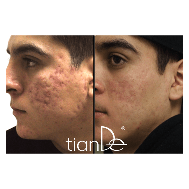 Tónico Facial Terapéutico para Eliminar el Acné y Piel Grasa Master Herb.