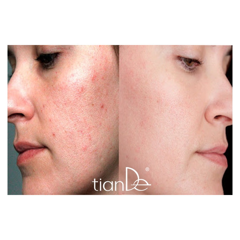 Gel Facial Terapéutico para Eliminar las Espinillas del Acné Bio-Complex Master Herb