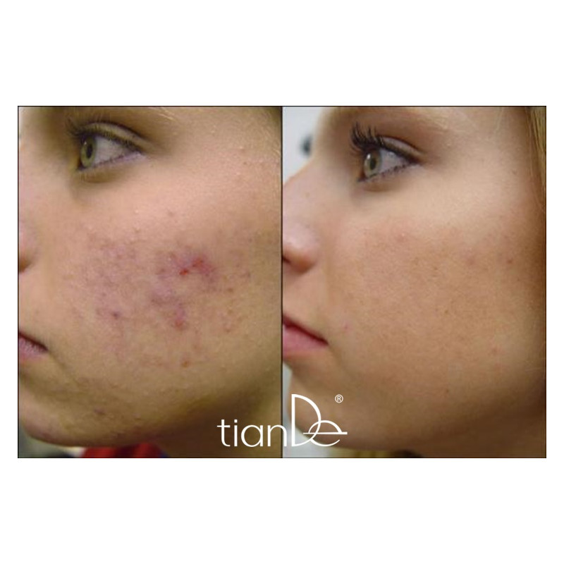 Crema Facial Terapéutica Anti-acné y Cicatrizante Master Herb.