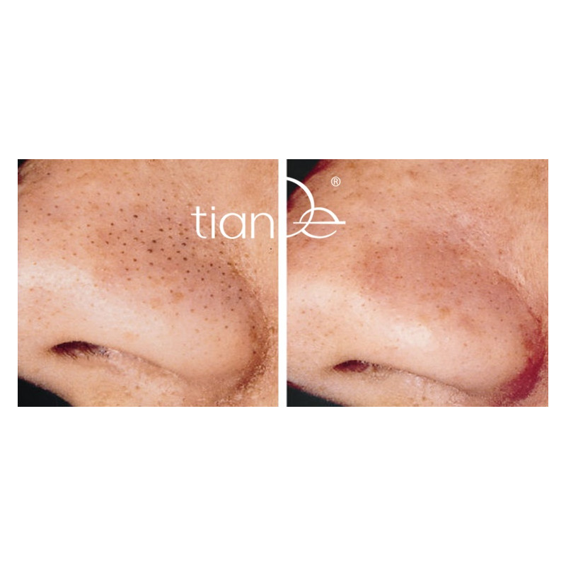 Tirita Limpiadora Desinfectante Anti-Acné y Puntos Negros Master Herb.