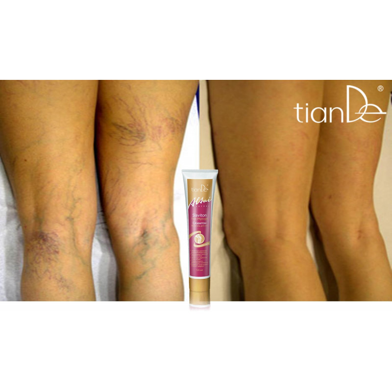 Gel de Masaje Anti-inflamatorio para Eliminar Varices y Piernas Cansadas Slaviton.